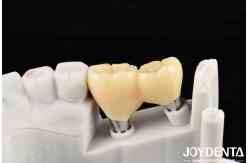 China Experience Aesthetically Pleasing Results With Customizable Implant Retained Crown And Bridge supplier