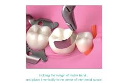 China Sectional Matrix Band Dental Use In Teeth M2 supplier