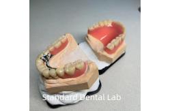 China High Esthetics CAD CAM Tooth Partial Denture Attachment Replacement Standard Dental Lab supplier