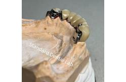 China High Esthetics CAD CAM Tooth Partial Denture Attachment Replacement Standard Dental Lab supplier