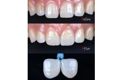 China Dental PFM Crown manufacturer