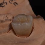 Full Contour Translucent Zirconia Crown for Aesthetically Pleasing Results for sale