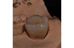 China Full Contour Translucent Zirconia Crown for Aesthetically Pleasing Results supplier