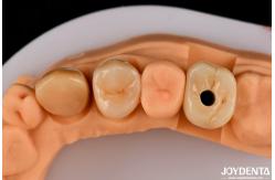 China Customizable Implant Crown and Bridge Achieve a Natural Look with Long-lasting Results supplier