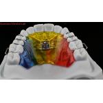 Teeth Expansion And Distalization Orthodontist Palate Expander China Dental Lab for sale