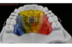 China Teeth Expansion And Distalization Orthodontist Palate Expander China Dental Lab supplier
