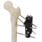 AO Type Proximal Femoral Orthofix External Fixator CE ISO9001 for sale