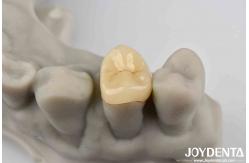 China Secure Cementation Emax Inlay Onlay Easy To Clean And Resistant To Staining supplier