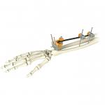 Medical Orthopedic Ulna Distal Radius Fracture External Fixation for sale