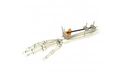 China Medical Orthopedic Ulna Distal Radius Fracture External Fixation supplier