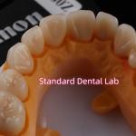 Dental Strong Layered Zirconia Crowns Full Upper Arch Restoration
