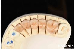 China Bionic Development Leaves And Distinct Layers Of Zirconia All-Ceramic supplier