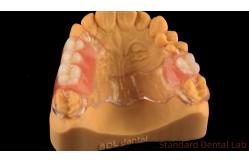 China Flexible Clear Metal Cast Framework Partial Dentures High Esthetics Perfect Fit supplier