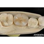 Adhesive Cementation Zirconia Dental Inlays And Onlays Natural Looking for sale