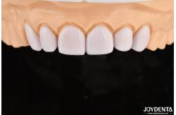 China Dental Veneers for Misaligned Teeth Biocompatibility And Gentle On Oral Tissues supplier