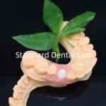 Esthetic Valplast Flexible Dentures with Free Redo Policy in 3 Days China Dental Lab for sale