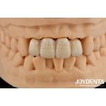 Biologically Oriented Preparation Technique BOPT For Accurate Dental Preparation