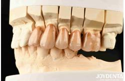 China Bionic Development Leaves And Distinct Layers Of Zirconia All-Ceramic supplier