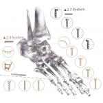 Orthopedic Implant Bone Fracture Titanium Locking Plate For Hands Foot