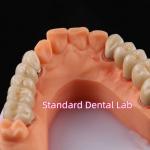 Digital Non Precious Metal Porcelain Crown PFM Bridge Dental for sale