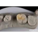 Strong Resistance To Fracture Emax Inlay Onlay Natural-looking Esthetics And Durability for sale