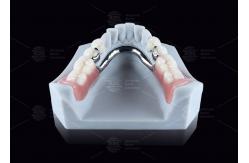 China CEKA M2 Precision Attachment Titanium With 3mm Horizontal / Vertical Clearances supplier