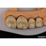 Premium Gold and Palladium Alloy Dental Crowns for Enhanced Durability for sale