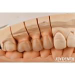 High Chipping Resistance And Natural-looking Esthetics With Multilayer Full Zirconia Technology