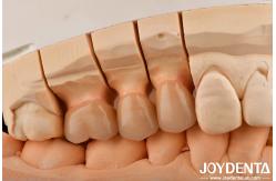 China High Chipping Resistance And Natural-looking Esthetics With Multilayer Full Zirconia Technology supplier