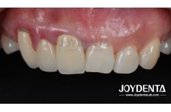 China Painless Procedure BOPT Dental Technique for Accurate Tooth Preparation supplier