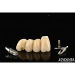 Customizable Implant Crown And Bridge In Porcelain Precision For Perfect Function for sale