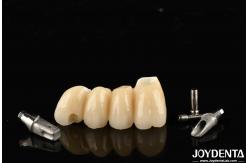 China Customizable Implant Crown And Bridge In Porcelain Precision For Perfect Function supplier