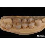 Natural Looking Emax Inlay Onlay Long Lasting Dental Restoration 0.5mm 1mm 1.5mm Thick for sale