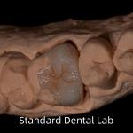 Translucency Emax Zirconia Dental Inlay Onlay Crown For Restore Natural Cavity Shape for sale