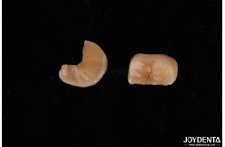 China Zirconia Inlay Onlay With Adhesive Cementation For Damaged Teeth Restoration supplier