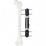 Orthopedic Medical Implant Straight Type External Fixator Ex Fix Device for sale