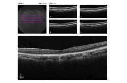 China 3mm Fundus Optical Coherence Tomography Machine Checking Macular Degeneration supplier