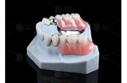 China Silver Key And Keyway Attachment Easy Maintenance Precision Attachment Dental supplier