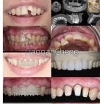 Biocompatibility Safe Zirconia Dental Crowns For Long-term And Implant-supported Restorations for sale