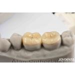 Emax Inlay Onlay Precise Fit And Hypoallergenic Biocompatibility Easy To Clean