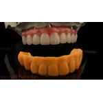 5 Year Guarantee Dental Implant Crown PMMA Bridge Over Multi Unit Abutments Customized Vita Shade for sale