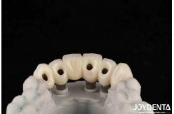 China Customizable Implant Crown And Bridge For Safe Oral Biocompatibility supplier