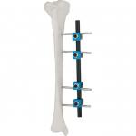 Quality Assured Orthopedic Surgical Instruments Tibial External Fixator AO External Fixation Orthopedic Implant for sale