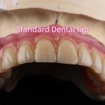 Fast Cement and Save Time Implant Products Dental Zirconia Crowns Bridge for sale