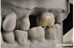 China Strong Resistance To Fracture Emax Inlay Onlay Natural-looking Esthetics And Durability supplier