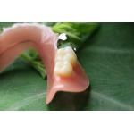 Partial Removable Acrylic Partial Denture