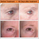 2 years warranty hifu  hifu hifu wrinkle removal