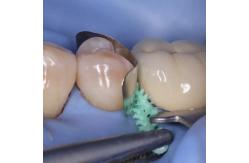 China Composite Dental Sectional Matrix System Plastic Adaptive Wedges W3 1.0 supplier