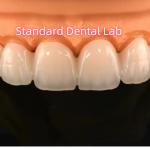 Zirconia Crowns Bridge Dental Lab With Layered Porcelain for sale