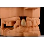 Internal Hex 3.0mm Depth 1.5mm Pitch Single Titanium Tooth Implant Replacement